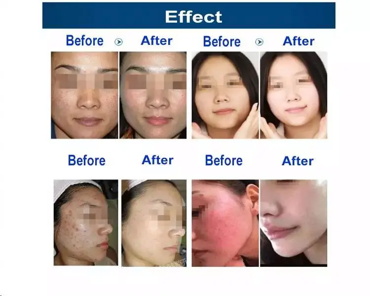 High Frequency Diamond Crystal Hydro Micro Wand Microbrasion And  Microdermabrasion