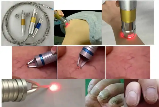  GOMECY лазерный диод 980nm компонент лазерная липосакция обезболивающая машина