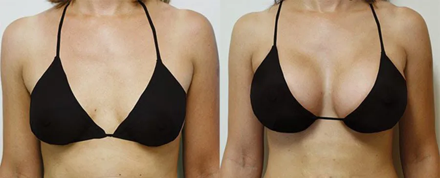 Wholesales Price 24mg/ML Ha Dermal Filler Injection Cross-Linked Hyaluronic Acid Korea Dermal Filler