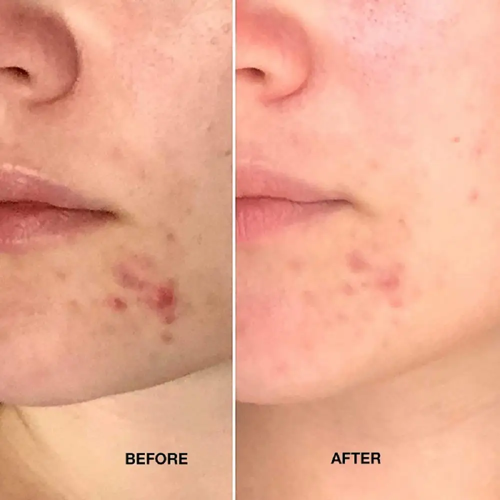 
OEM Customized Acne Treatment Scar Removal Face Care Organic Tea Tree Serum 