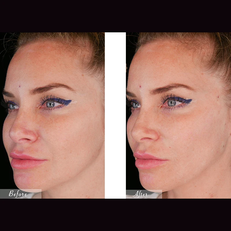 Wholesale hilos tensores fio pdo lift molding thread cosmetic grade cones cog face lifting thread pcl pdo plla