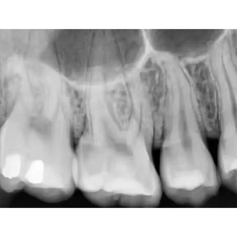 High Frequency Portable Dental X-ray Machine