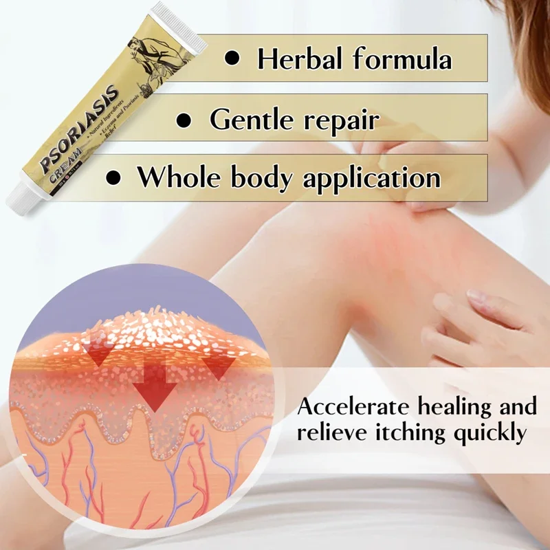 hot selling fungal infection skin psoriasis cream dermatitis eczema ointment treatment psoriasis cream skin cream