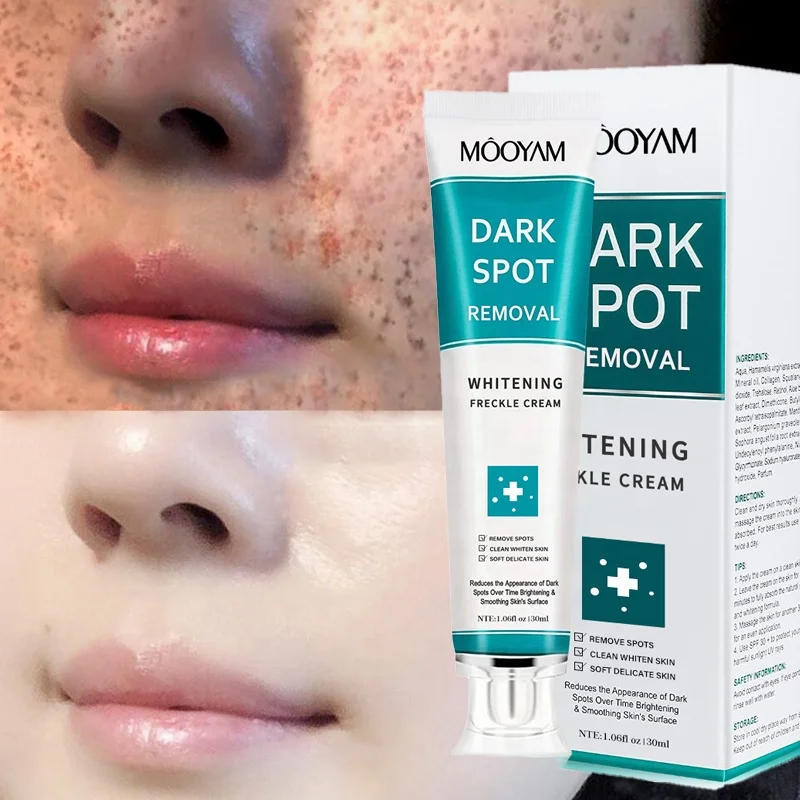 Customized Original Strong Anti Freckle Whitening Cream Powerful Removing Age Dark Spots Pigmentation Whitening Cream