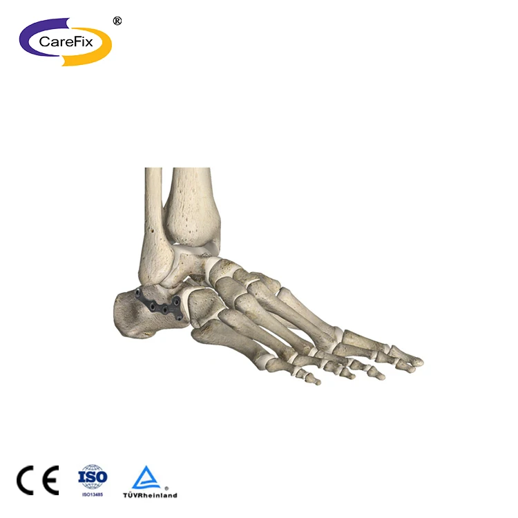 Straight Locking Mini Plate screw for foot ankle elbow fracture LCP meditech orthopedic implants