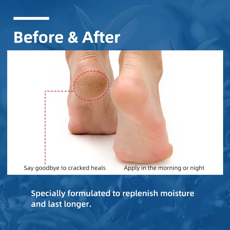 Sumax Wholesale 40% Urea Cream Foot Skin Care Cream For Dry Cracked Foot Heel