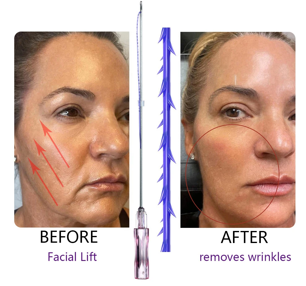 Амортизаторы для лица Korea, 19 г, 100 мм, винты 4d Hilos Tensores Fios De Pdo