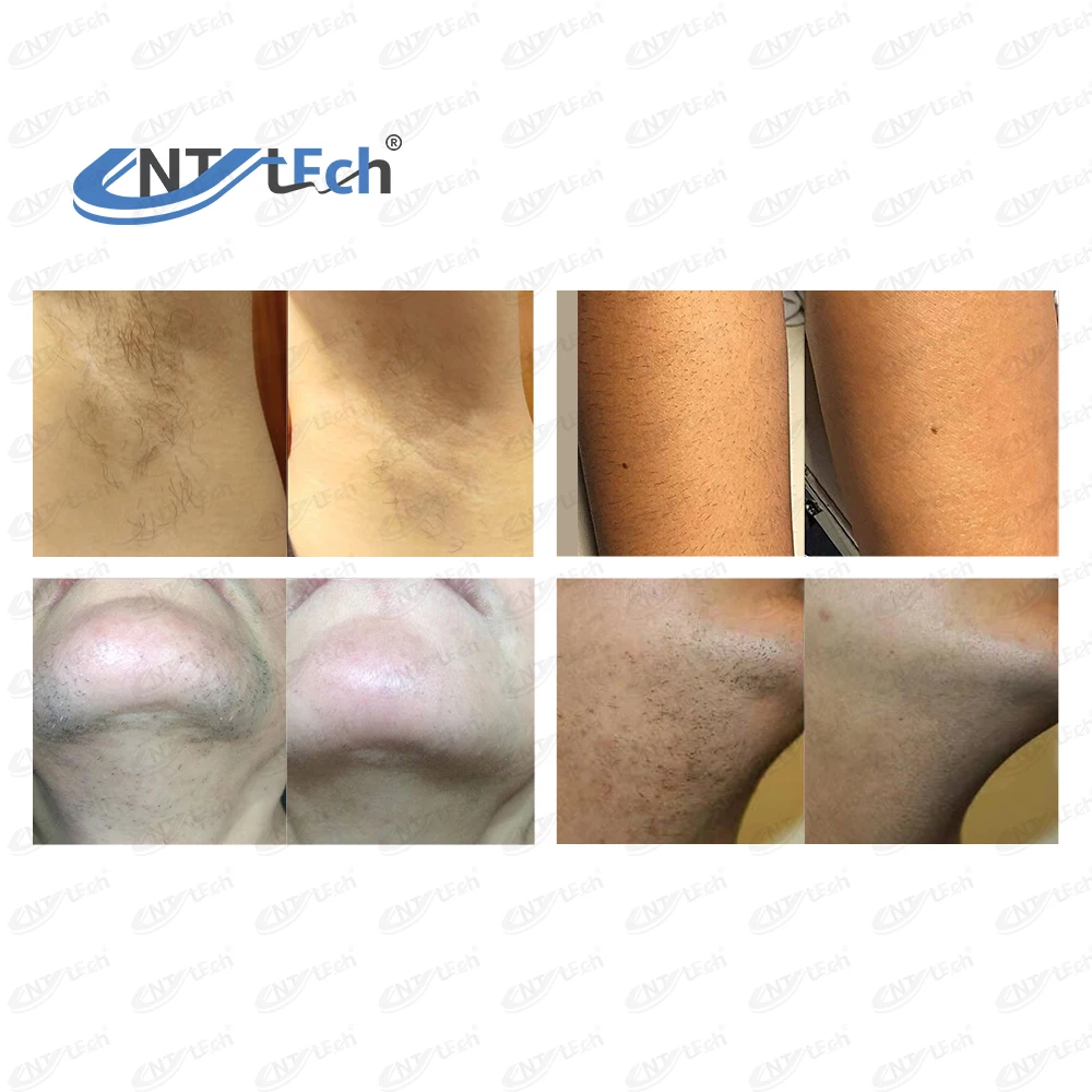 Beijing unt android system 800w 808nm diode laser hair removal machine with skin analyzer