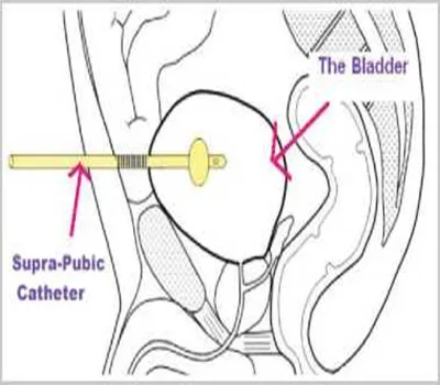 Super Pubic Catheter