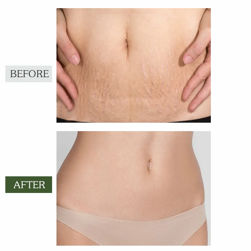 OEM Custom Private Label 100% Natural Plant Extract Body Care Oil Scar Repair Anti Stretch Mark Remover Essential Oil