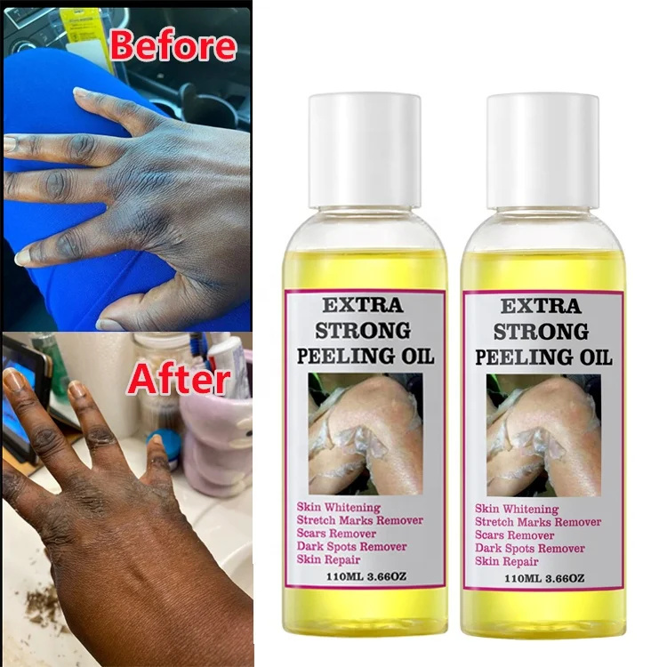 Extra Strong Peeling Oil Scar Remove Stretch Marks Whitening Yellow Peeling Oil