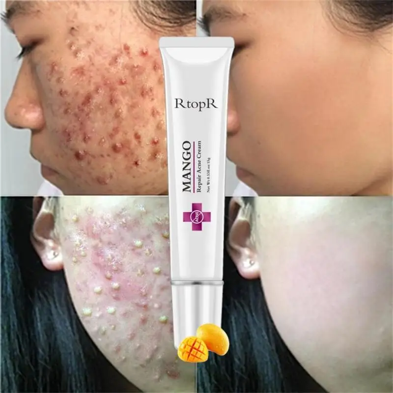 Repair Acne Cream Anti Spots Whitening Moisturizing Face Cream Face Skin Care  Anti Spots Acne Treatment acne removal Cream