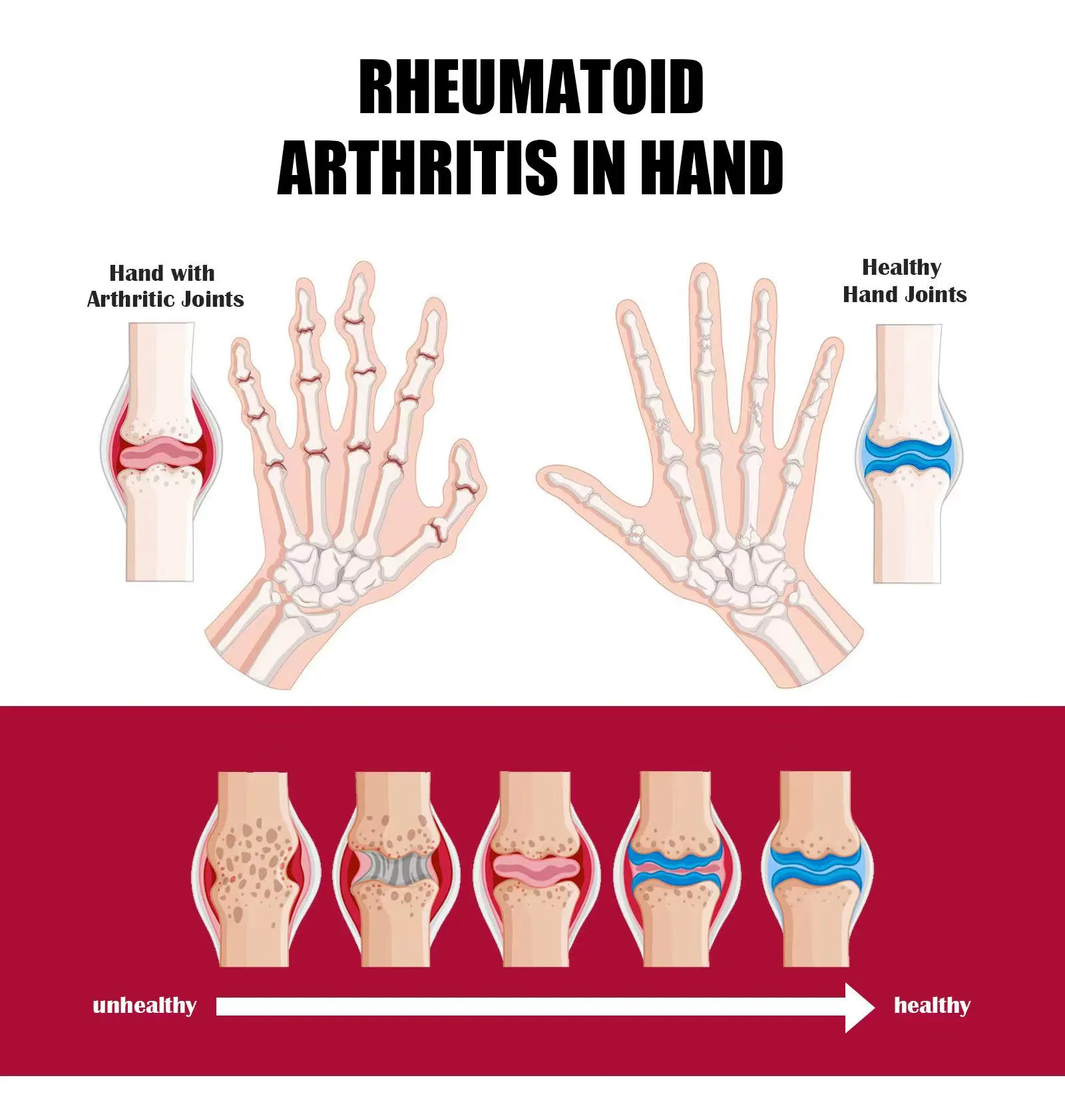 Relieves Sore Bones And Corrects Deformed Joints Perfect Intensive Concentrate Cream Joint & bone Therapy Collagen Cream
