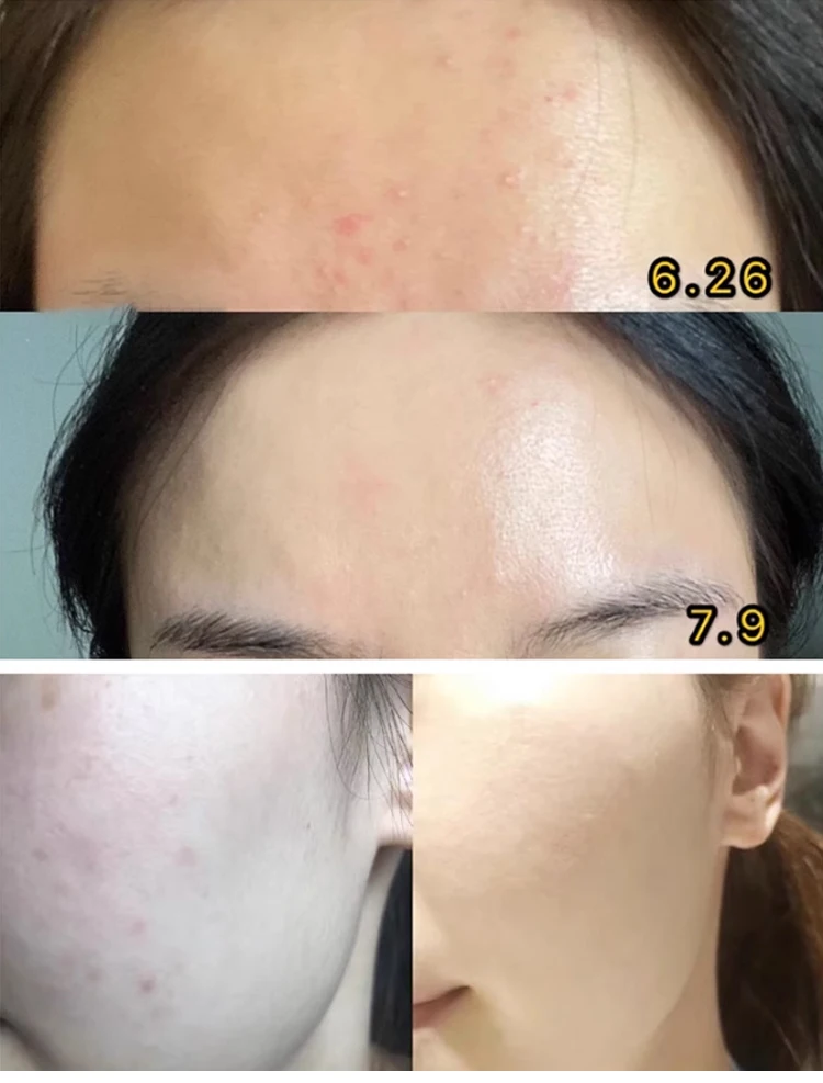 OEM Azelaic Acid Soothing and Acne Removing Ointment Lightening Acne Marks Soothing and Moisturizing Acne Repair face cream