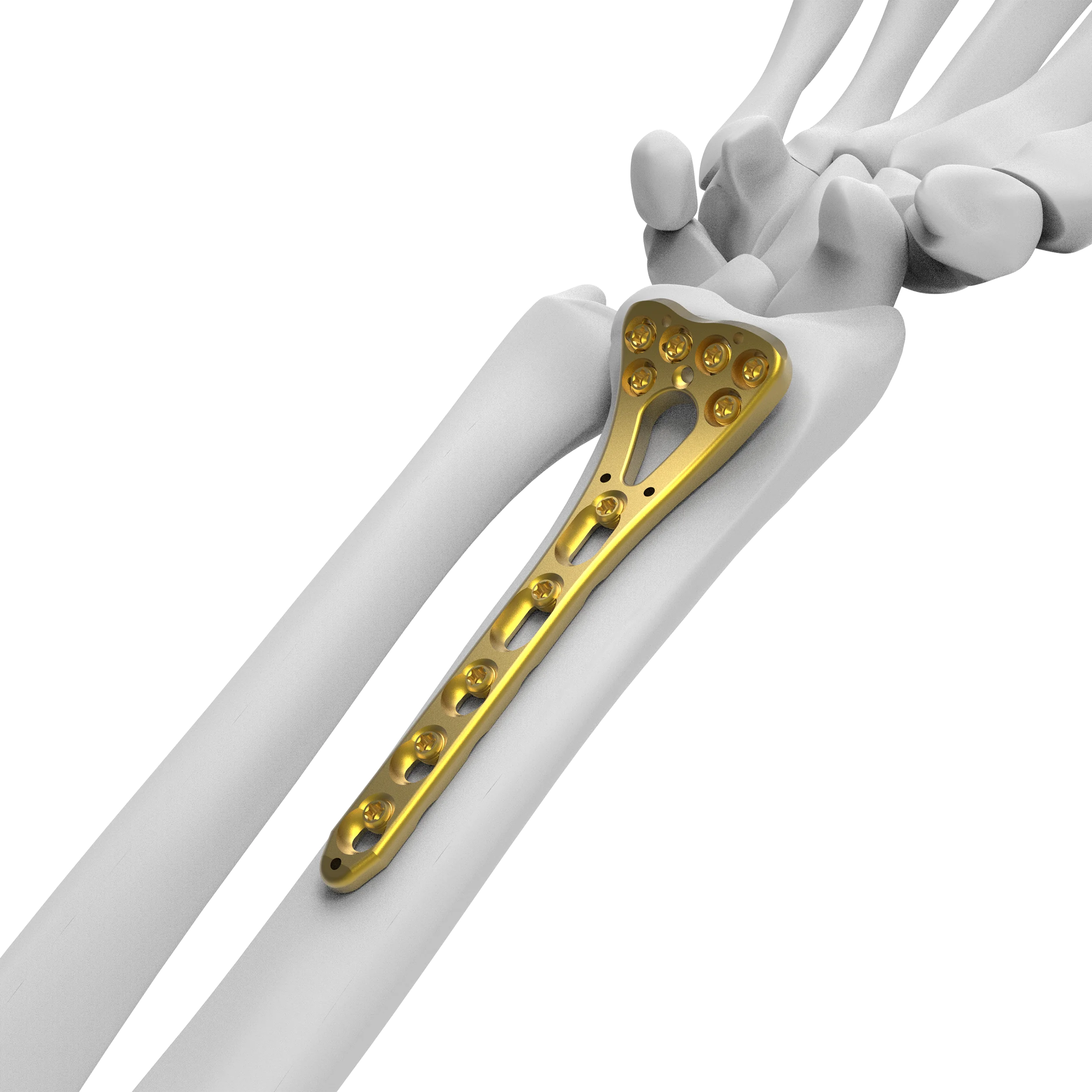 CANWELL Variable Angel Distal Radius Locking Plate Distal Radius Volar Locking plates