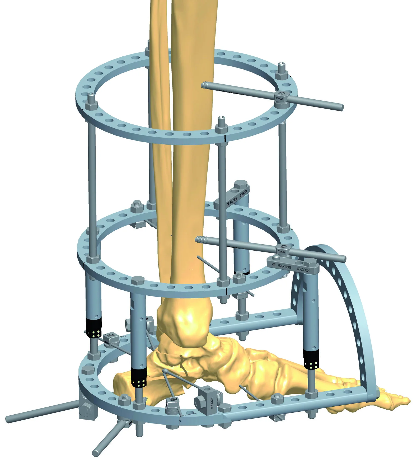 
Hot Sale Black Stainless Steel Elbow Joint External Fixator 