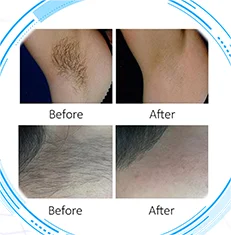 SummerStar 2024 Latest Production Hair Removal 808nm Diode Laser In Commercial