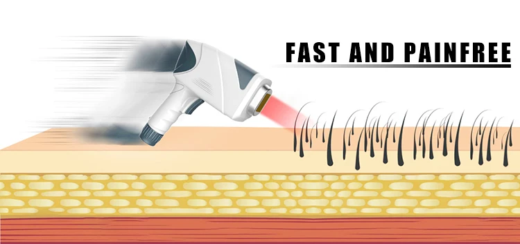 Permanent painless big spot size 15mm*30mm triple wavelength diode laser hair removal for sale