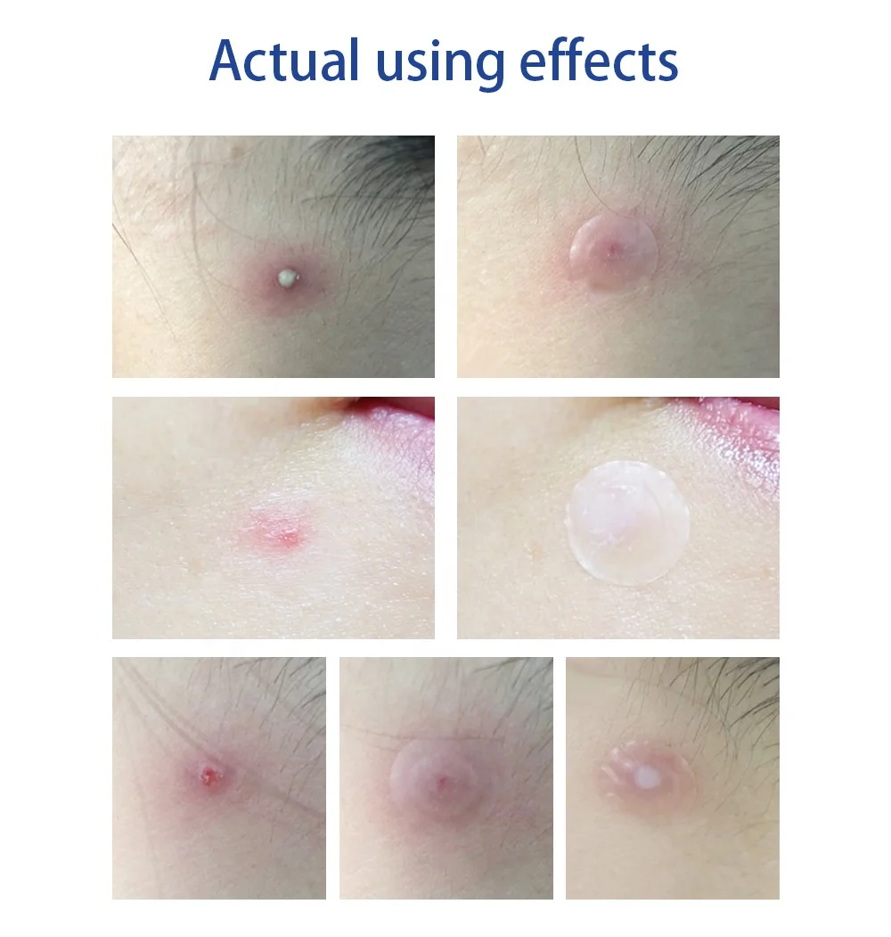 LANBENA Acne Pimple Patch 28pcs Invisible Acne Stickers Blemish Treatment Acne Master Pimple Remover Tool Skin Care Face Cream