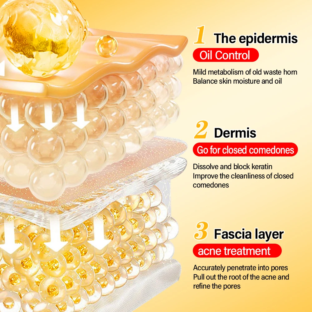 Colloidal Sulfur Anti-acne Serum For Acne Treatment Balancing Water Oil Improving Acne Scars Face Serum
