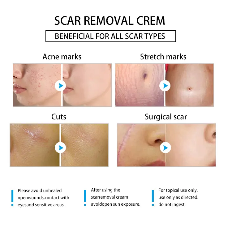 OEM/ODM Private Label Old Scar And Dark Spot On Leg Remover Cream Scars And Acne Marks Remove Cream Pregnancy Scars Acne Cream