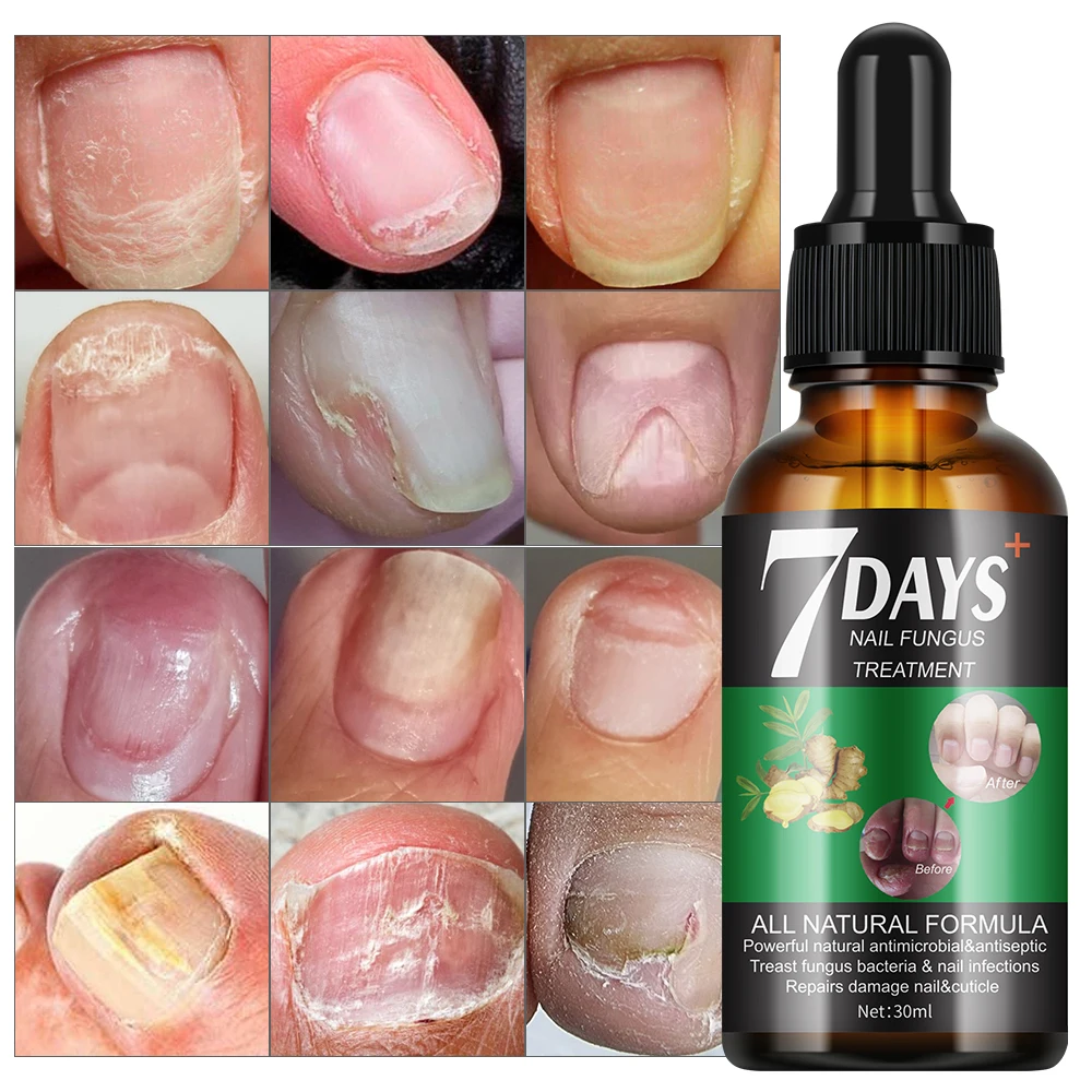 7 Days Nail Fungus Treatment Serum Repairs Damage Nail & Cuticle Treast Fungus 30ml MOOYAM Nail Fungus Treatment Serum