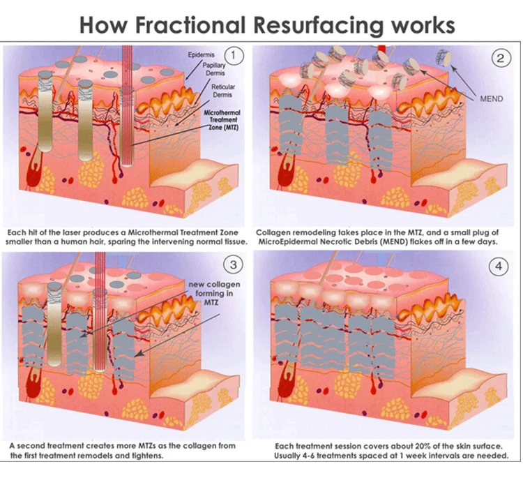 ADSS New Design Co2 Fraccionado / Co2 Fractional Laser Vaginal Tightening Machine