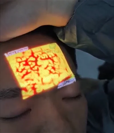 VF15 Powerful performance portable vein viewer for hands and feet and to detect face fillters