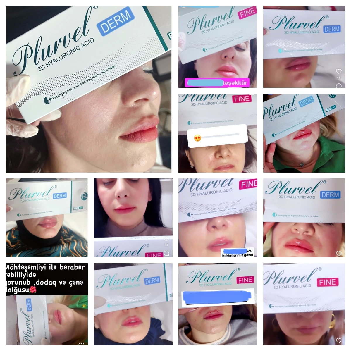 Source manufacturers supporting OEM Profhilo 64mg H+l injection Anti-wrinkle Polynucleotides Eye Skin Booster 2ml Made In Korea