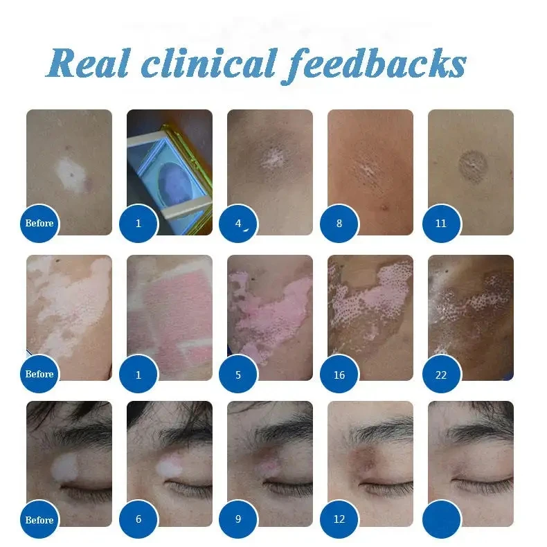 Mini Portable Psoriasis Vitiligo Treatment Lamp Uv 311nm Excimer Laser 308nm Uvb Led Phototherapy 308 nm vitiligo lamp