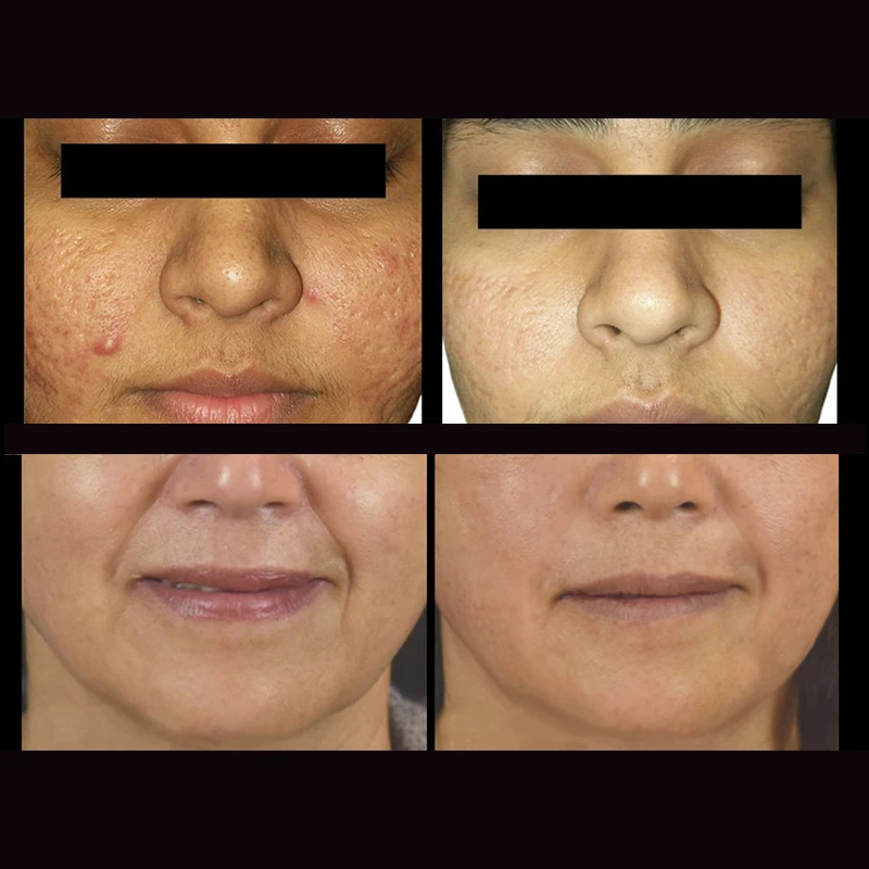 korean absorbable suture aptos thread lift silhouette soft beauty skin care pdo 3d 4d cog pdo thread face lift