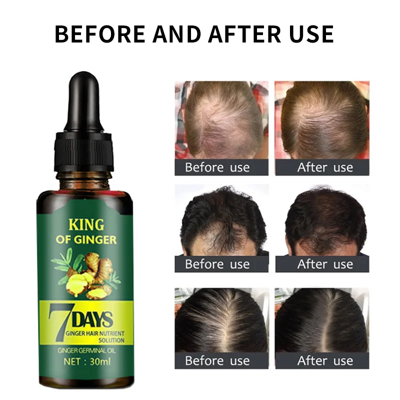OEM&ODM Factory Best Hair Growth Oil For Baldness Scalp Repair Free Sample