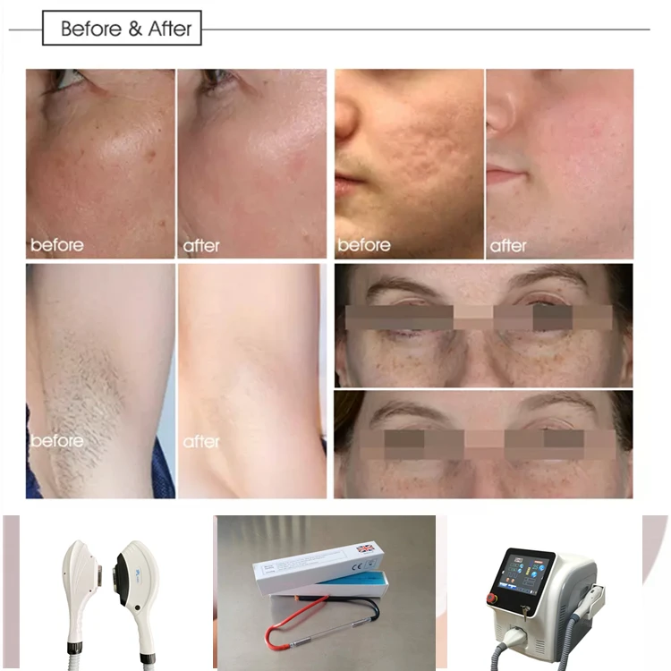 New style sapphire ipl skin rejuvenation / opt ipl hair removal treatment filters handle IPL pulse anti-wrinkle