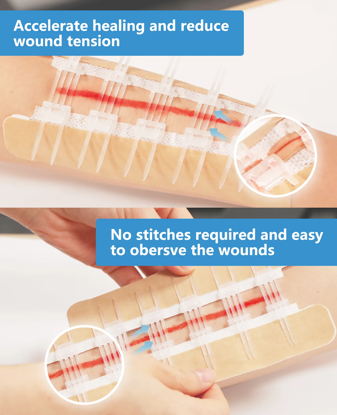 BLUENJOY Sterile Skin Color Wound Closure Device First Aid Wound Care Zip Stitch Wound Device