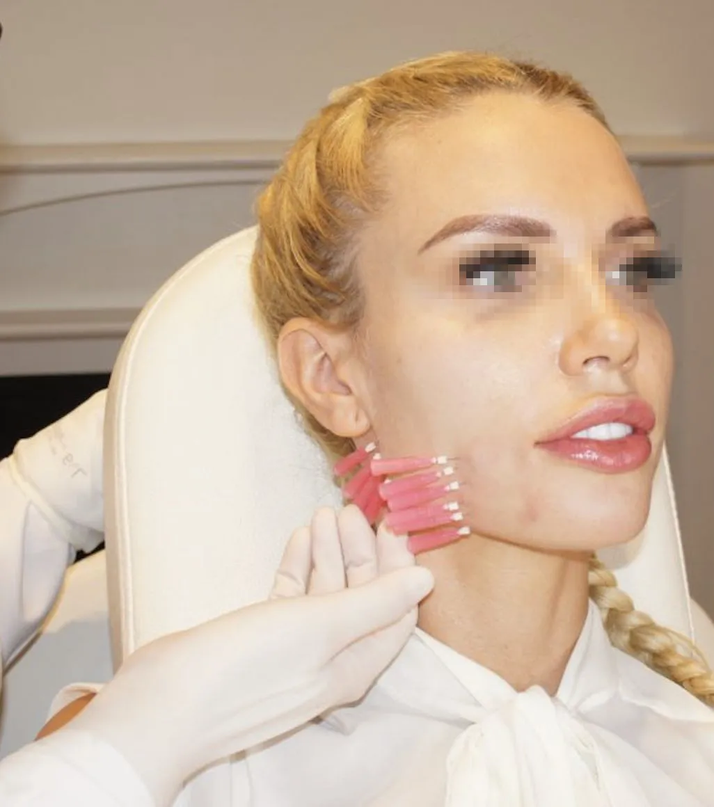 Новинка 2021, высокое качество, анти-старение, рассасывающиеся одиночные винты, полидиоксанон, мононити, Ког, ПДО, нити для губ, подтяжка кожи