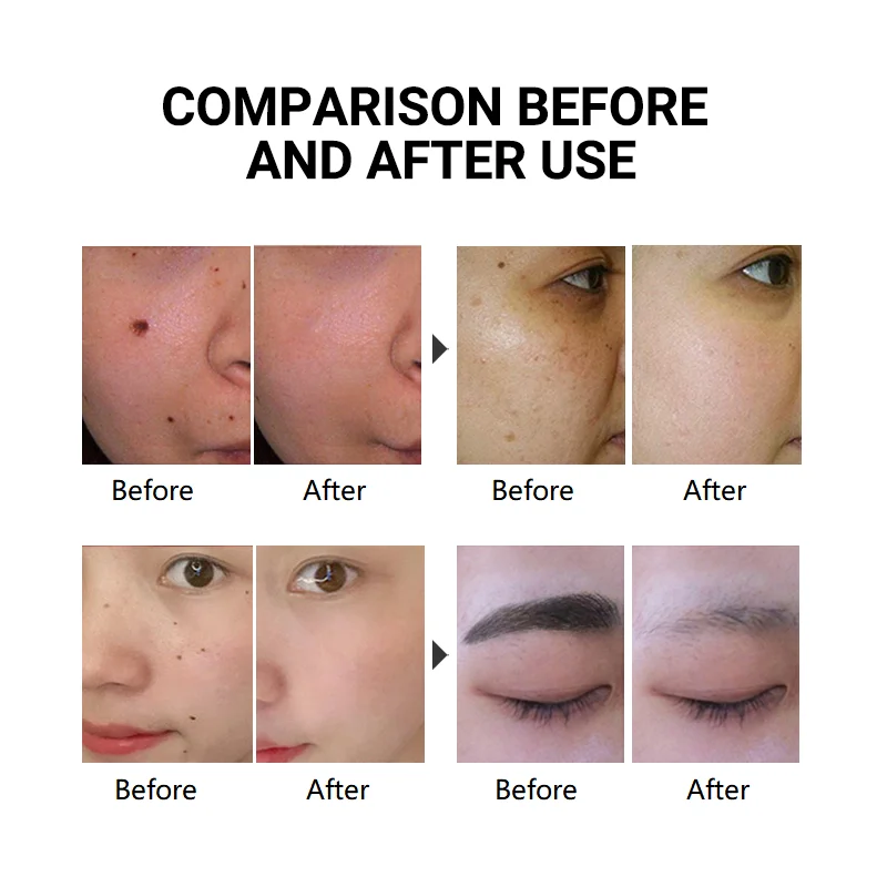 MOOLWEEL портативный лазер для домашнего использования, ручка для удаления татуировок меланина, лазерное устройство для удаления родильных пятен, пикосекунда