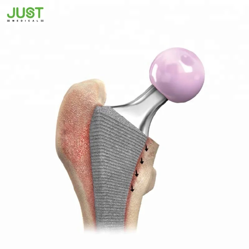 
HARMONY Cementless femoral stem hip arthroplasty titanium hip joint replacement prosthesis 