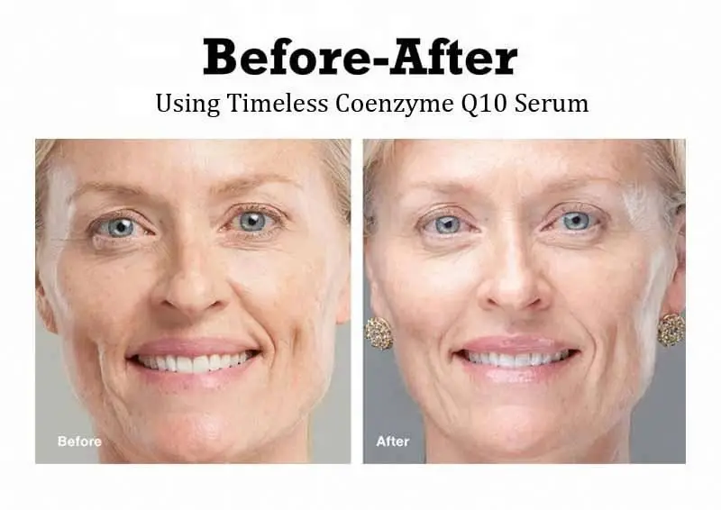 Timeless Anti Wrinkle Serum COENZYME Q10 Matrixyl 3000 Hyaluronic Acid ordinary Face Serum