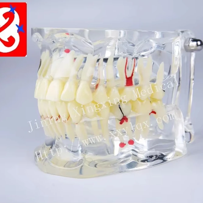 Adult pathological dental model with missing tooth caries apical cyst, tartar ,implant etc