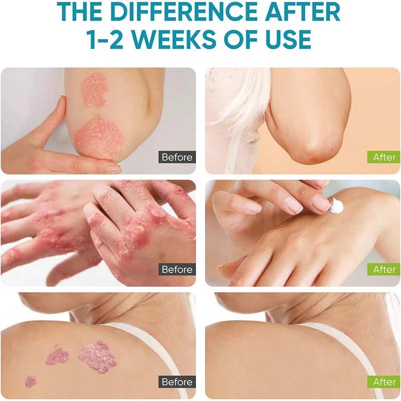 High Quality Natural Skin Care Treatment Psoriasis Eczema Herbal Cream