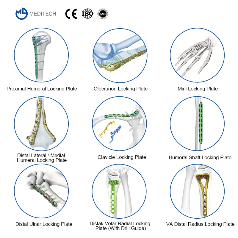 Medical Trauma Orthopedic Implants Titanium Proximal Humerus  Fractures Plate Proximal Humeral Locking Plate