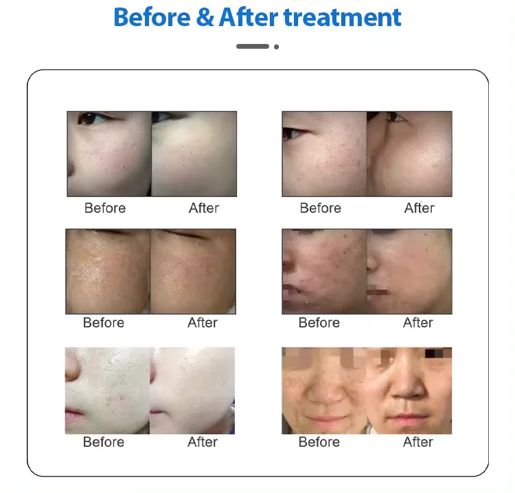 Ipl Opt Dpl Hair Removal And Skin Rejuvenation Machine