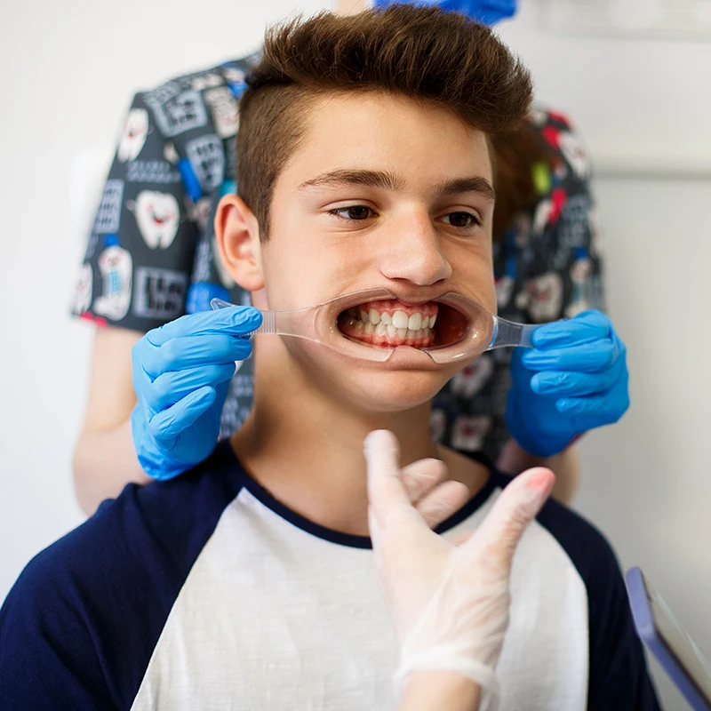 Mouth Opener Orthodontic Dental Lip Cheek Retractor Extender Mouthopener