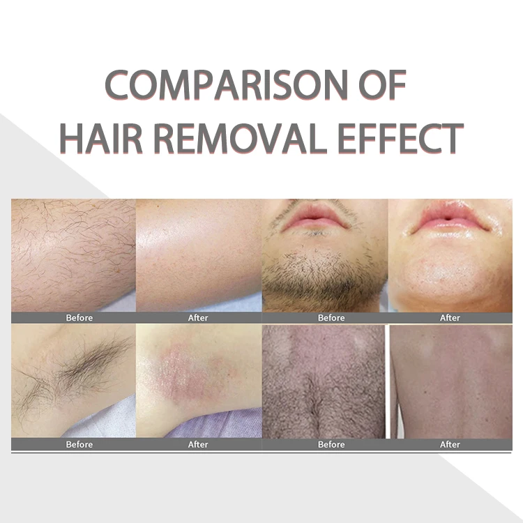 2024 808nm diode laser hair removal 2000w triple laser 755 810 940 1064 nm 808 diode laser hair removal equipment