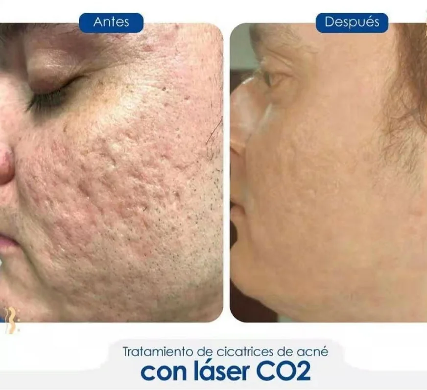 Medical Co2 Fractional Laser Skin Rejuvenation Acne Scar Removal Co2 Fractional laser Machine