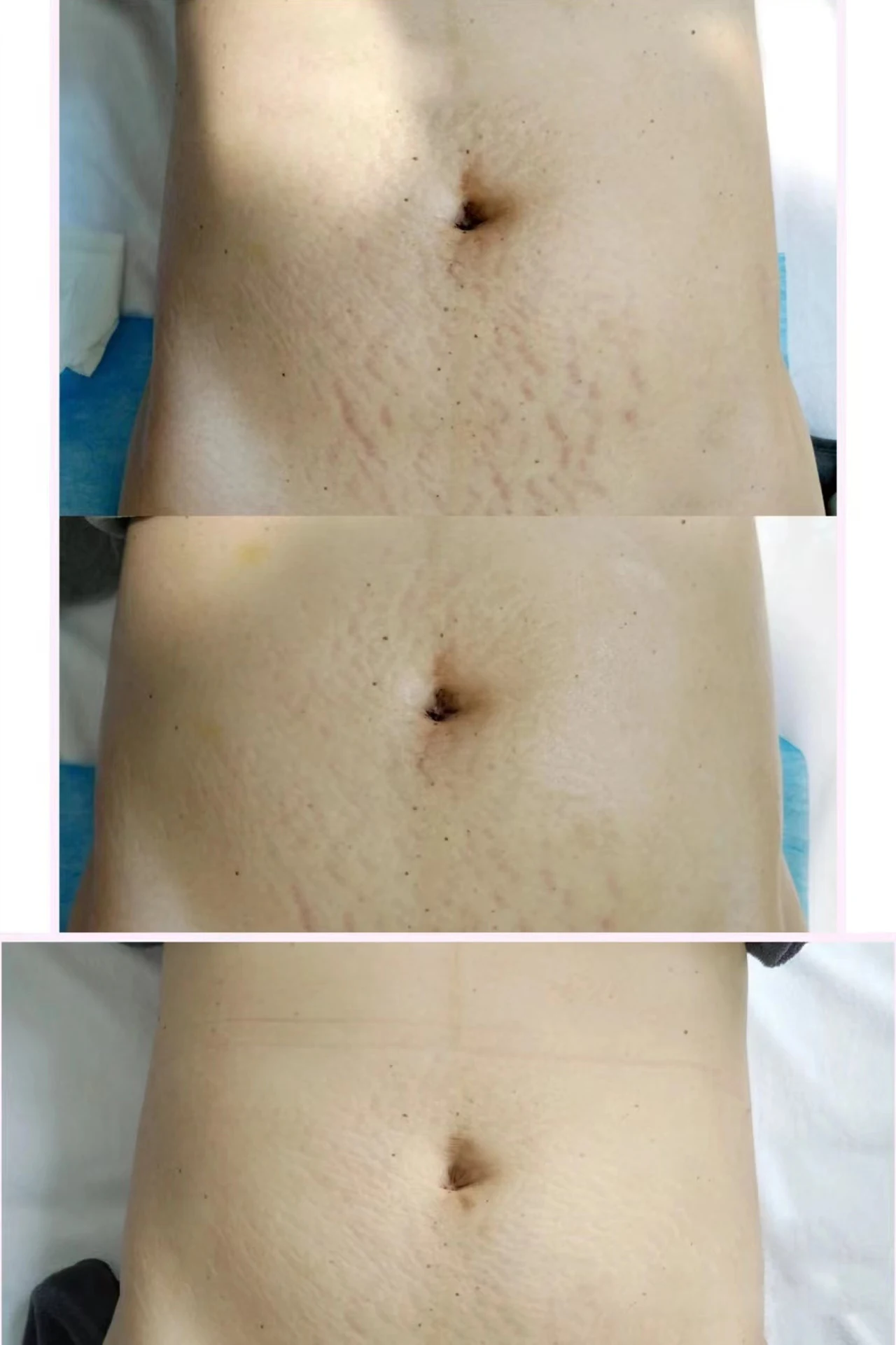 Spongilla Spicule 5Ml Patch Microneedling Scars Seaweed Whitening Melasma Sponge Microneedle Algae Peel Serum For Acne