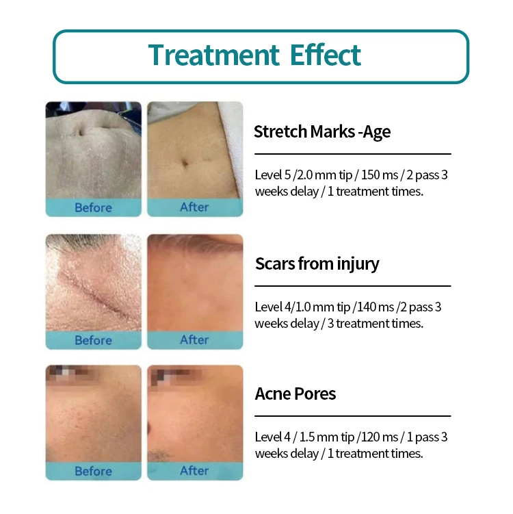 KES Portable Micro Needle Fractional Rf Facial Lifting Machine Fractional RF Microneedle for Face Treatment