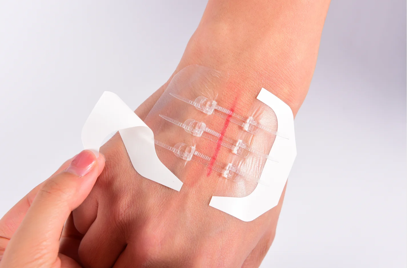 Medical Sterile Skin Closure Device Noninvasive Zip Without Stitches Sterile Strips Without Threads Dressing Wound Closure Strip