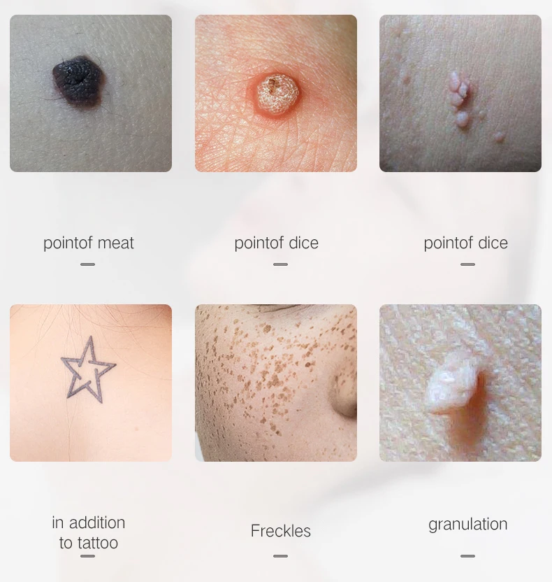 Portable Dark Spot Skin Tag Remover Pen Home Use Professional USB Beauty Laser Mole Removal  Plasma Pen