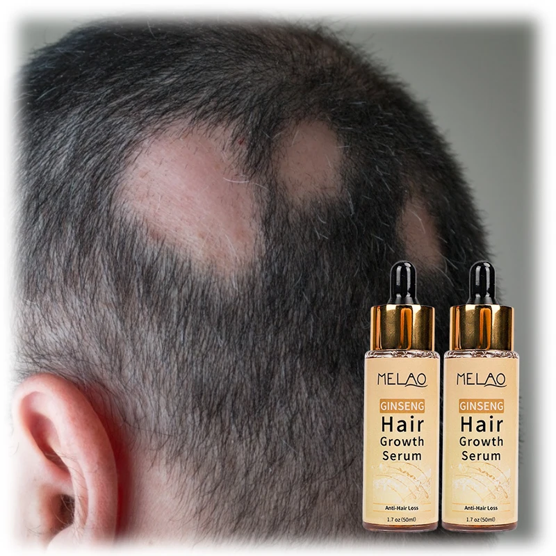 OEM 100% Pure Natural Organic Scalp Essential Oils Anti Hair Loss Product Ginseng Hair Growth Serum